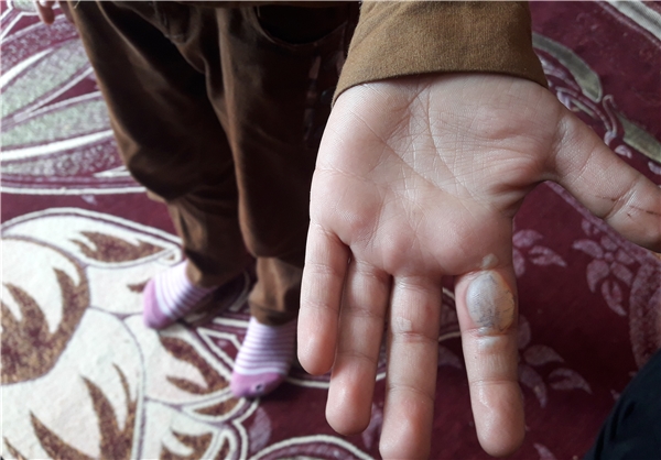 تنبیه دانش آموز با سوزاندن دست ! / توضیحات معلم و رئیس اداره منطقه